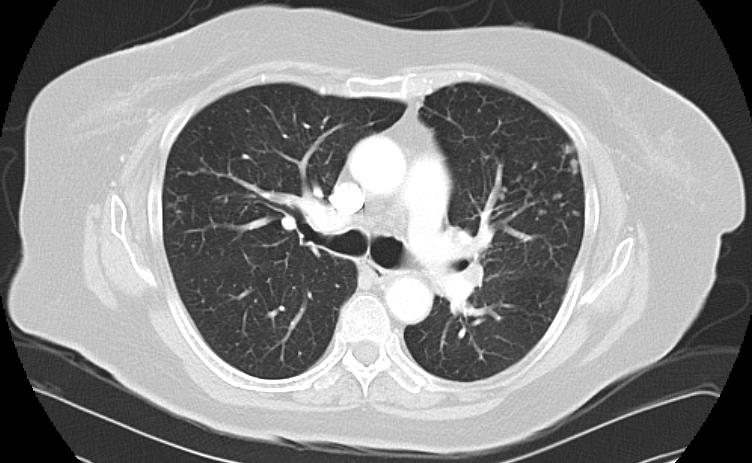 Our patient: Tree in bud Axial C+ CT Chest