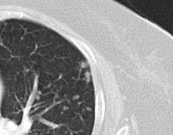 nodular opacities in the lung periphery