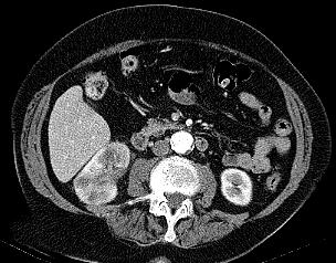 Our Patient: Incidental finding of multiple renal masses C+ CT Chest C+ CT Chest