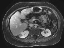 Our Patient: Multiple enhancing renal masses Axial