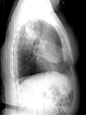 Our Patient: Suspicious LUL mass Frontal Scout CXR Lateral Scout CXR 30mm There is a 3cm rounded, non-calcified opacity without distinct borders or air-fluid level in the left upper lung at the level