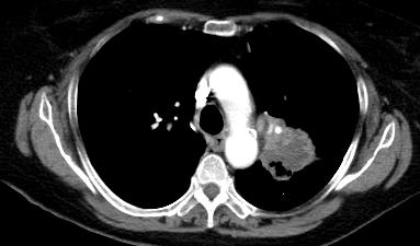 Our Patient: Distinct features of LUL mass Axial C+ CT Chest Using soft tissue windows, we see that the tumor is continuous with the mediastinum but there is no evidence of mediastinal invasion.