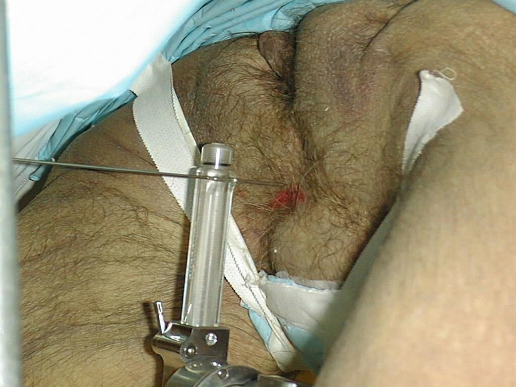 Robotic prostate