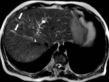 246 MRI of the Liver c Fig. 13-c. Primry sclerosing cholngitis. T2-weighted imges (, ) show intrheptic, fusiform, hyperintense, ductl dilttion (rrows) ssocited with ductl stenosis (rrowheds).