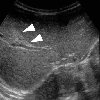 (sterisk) with thinned wll is seen Fig. 15,.