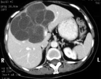T2-weighted HASTE imges cquired in the xil plne () nd True-FISP imges cquired in the coronl plne () revel lrge, loulted cystic lesions in the right liver loe.
