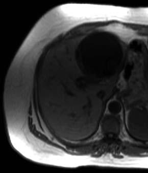 On the unenhnced T2-weighted HASTE imge (), hyperintense, cystic lesion