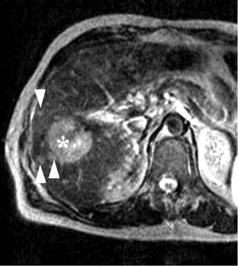 260 MRI of the Liver Fig. 32,. Cholngiocellulr crcinom.