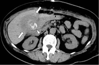 Most ptients with crcinom of the gllldder present with either cute cholecystitis or symptoms of mlignncy, including constnt right upper dominl qudrnt pin, mlise, weight loss, nd jundice.
