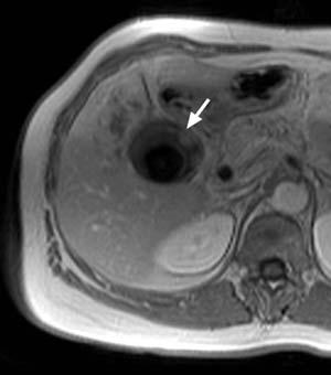 crcinom. In the heptoiliry phse (g), the infiltrted res of the right liver loe re once gin hypointense, evidencing the mlignnt nture of the lesion.