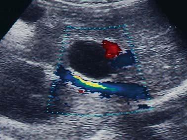 On Color Doppler US the choledochl cyst does not show ny vsculriztion is dignostic procedure tht demnds technicl expertise nd numer of sfety mesures, nd it is not without complictions.