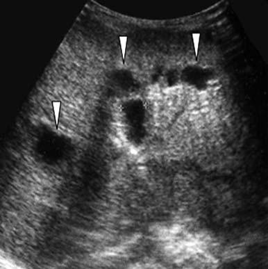 244 MRI of the Liver Fig. 8. Croli disese.