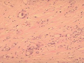 Tumor- Case 2) 29 p Dx Extrahepatic Ductal Cholangiocarcinoma n W/U pruritis, jaundice n US, CT,