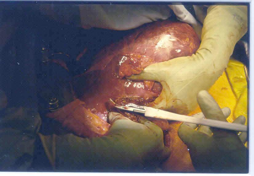maneuver n Parenchymal dissection along anatomic lines p Ligasure