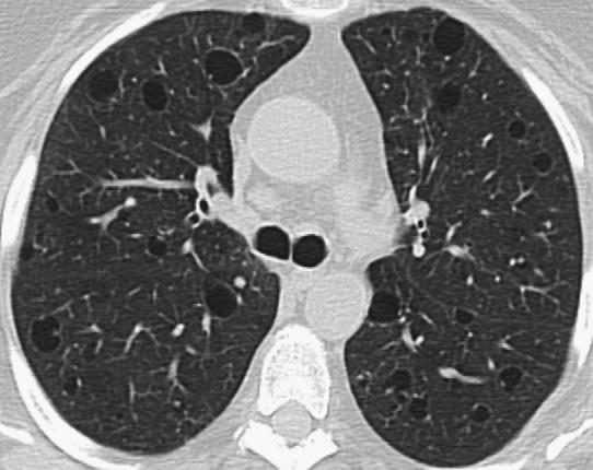 Interstitial Lung Disease 137 Clinical Features Like other forms of CTD-ILD, the prevalence of lung involvement in Sjögren syndrome depends on the methodology used to determine active disease and