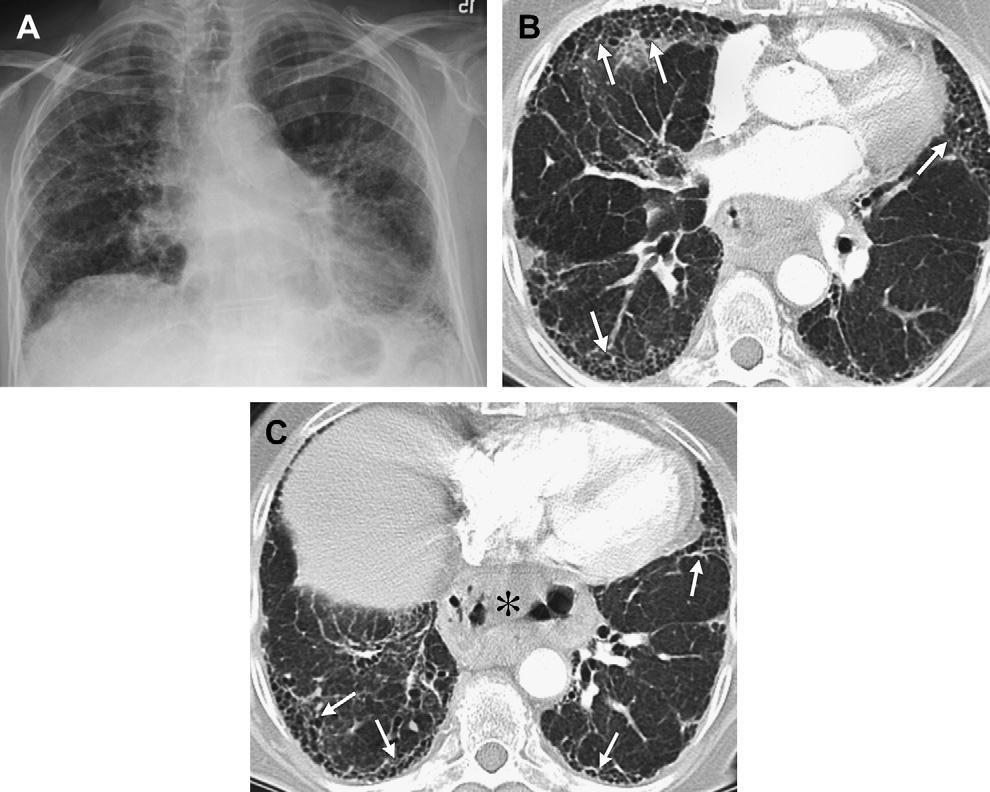 Interstitial Lung Disease 127 Fig. 1. A 73-year-old woman with a radiographic pattern of RA and UIP.