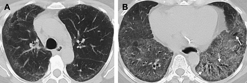 25-mm thick sections) computed tomography (CT) images at the level of the midthorax (B) and lower thorax (C) show peripheral reticular markings with architectural distortion and small subpleural