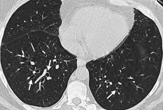 Interstitial Lung Disease 131 anti-ccp but no articular findings of RA; some may eventually develop clinical RA.