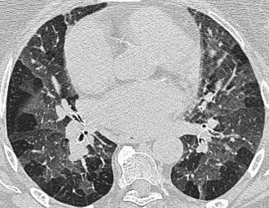 108,120 RA-ILD typically presents with progressive dyspnea, although cough and pleuritic chest pain may occur.