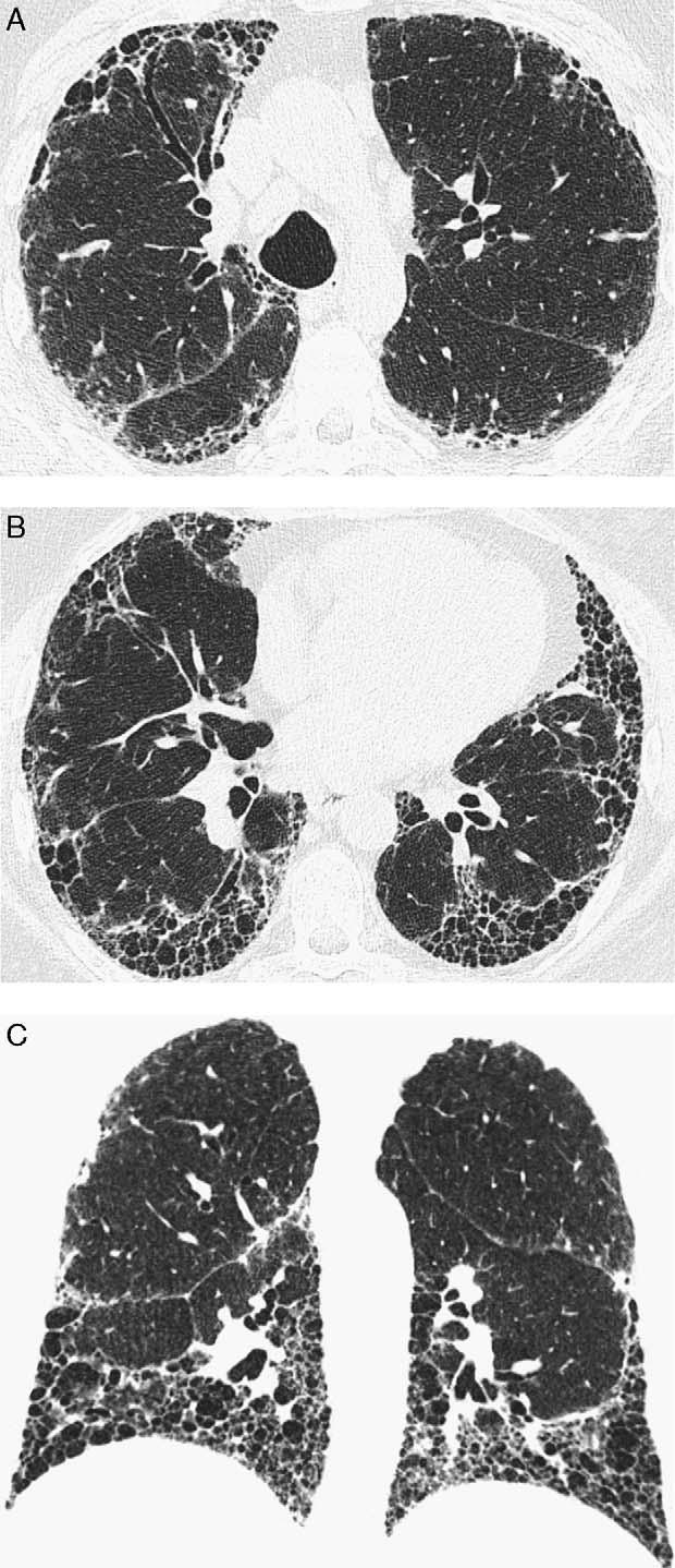 Silva and Müller J Thorac Imaging Volume 24, Number 4, November 2009 FIGURE 2. A case of idiopathic pulmonary fibrosis without honeycombing on HRCT in an 83-year-old man.