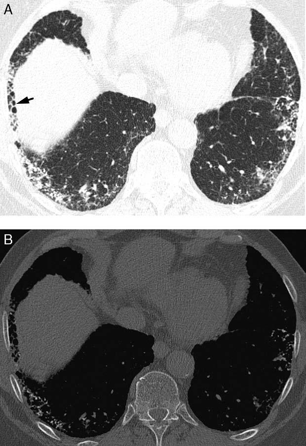B, HRCT image at the level of lung bases shows greater extension of peripheral honeycombing.