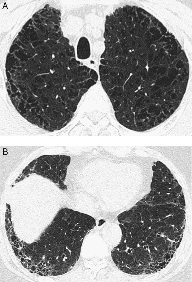J Thorac Imaging Volume 24, Number 4, November 2009 FIGURE 4. Emphysema and idiopathic pulmonary fibrosis in a 70-year-old man.