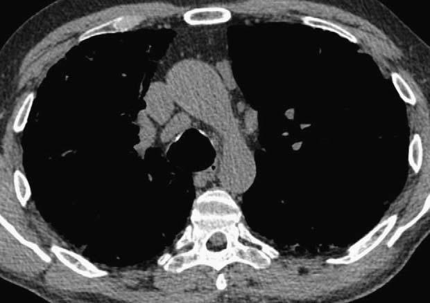 B, HRCT image at the level of the dome of the right hemidiaphragm shows mild emphysema and peripheral reticulation and honeycombing. FIGURE 6. Progression of usual interstitial pneumonia on followup.