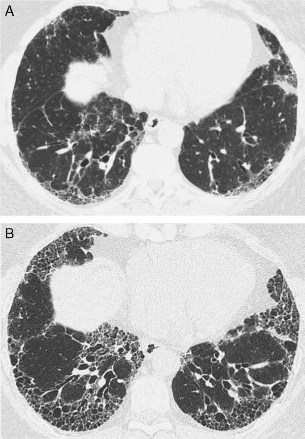 B, HRCT image performed 3 years later shows marked increase in the extent of reticulation and development of subpleural honeycombing.