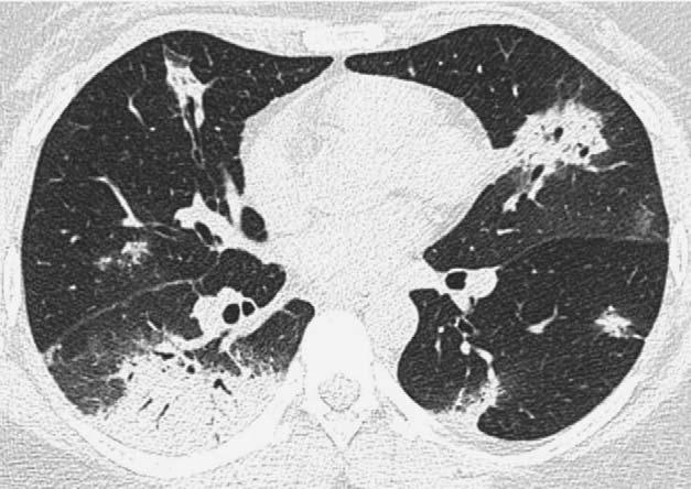 Silva and Müller J Thorac Imaging Volume 24, Number 4, November 2009 FIGURE 9. Cryptogenic organizing pneumonia in a 56-year-old man.