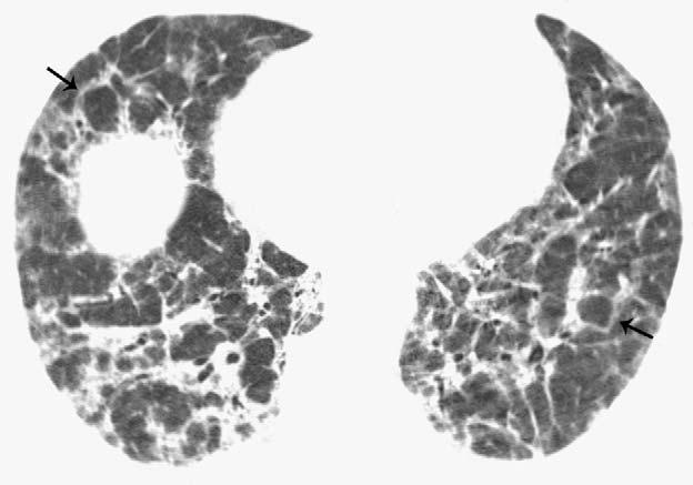 Cryptogenic organizing pneumonia in a 59-year-old man. HRCT image at the level of the dome of the right hemidiaphragm shows perilobular opacities (arrows).
