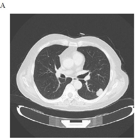 Fig. 1 A: Left lung 3 x 4.5 cm nodule diagnosed by needle aspiration biopsy as pulmonary metastatic tumor from HCC; B: Pulmonary metastatic tumor completely disappeared.