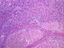 Focal Nodular Hyperplasia Normal-appearing hepatocytes in nodules partly