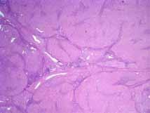 in fibrous tissue Bile ductular proliferation Fibrous bands Not too tough a