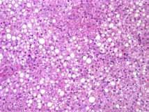 Focal Nodular Hyperplasia Rare hepatocellular neoplasm, almost exclusively in young women Rarely occurs in patients with metabolic disorders (tyrosinemia,