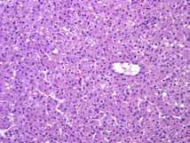 Vessels of varying size, but no portal tracts Absent mitoses Differentiating adenoma from well differentiated hepatocellular carcinoma Clinical Setting Hepatocellular carcinoma: Older/male patient,