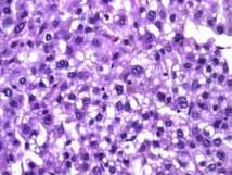 The histologic diagnosis of of hepatocellular carcinoma?