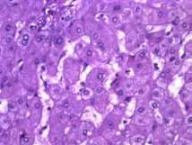 For the very well differentiated carcinoma, we would like to prove it is neoplastic.