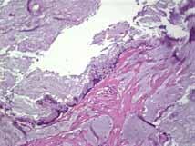 DPAM disseminated peritoneal adenomucinosis Peritoneal mucin
