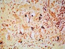Goblet cell carcinoid tumor of the appendix Is this a type of carcinoid tumor, a type of adenocarcinoma, or what? How does it behave?