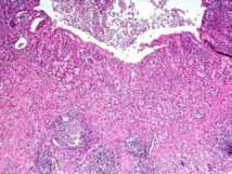 Is this really a carcinoid tumor? WHO classifies this as an endocrine tumor Why has it been categorized this way?