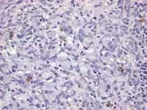 Is this really a carcinoid tumor? There are endocrine cells, but they are never the dominant cells; they are always a distant second to the goblet cells. Is this really a carcinoid tumor?