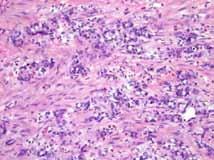 Goblet cell carcinoid with adenocarcinoma Goblet cell Carcinoids and Related Tumors Type Extent Mets Outcome Pure GCC App NO A & W Mixed GCC/Adenoca App/Invasion Yes 80% Fatal AdenoCA Burke, et al,