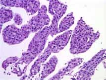 Even so, we are seeing more and more challenging biopsies The histologic diagnosis of hepatocellular