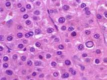 Cells resemble hepatocytes, with