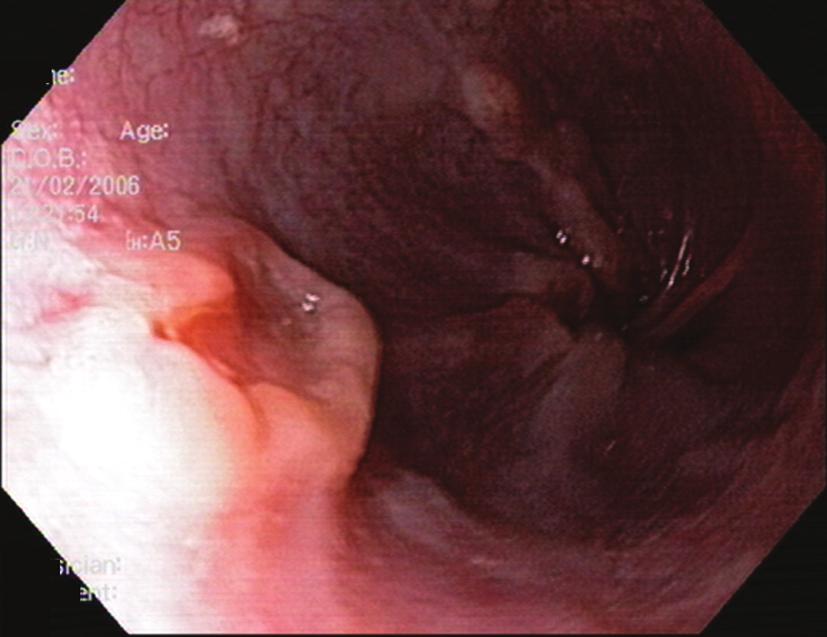 214 Tantau et al Endoscopic therapy Endoscopic therapy has become a viable alternative for patients with high grade dysplasia or early EAC (Figs.
