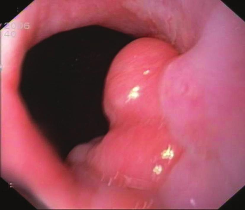 Endoscopic resection of the mucosa is recommended for lesions restricted to the mucosa and some experts recommend it also for lesions restricted to the superior 1/3 of the submucosa.