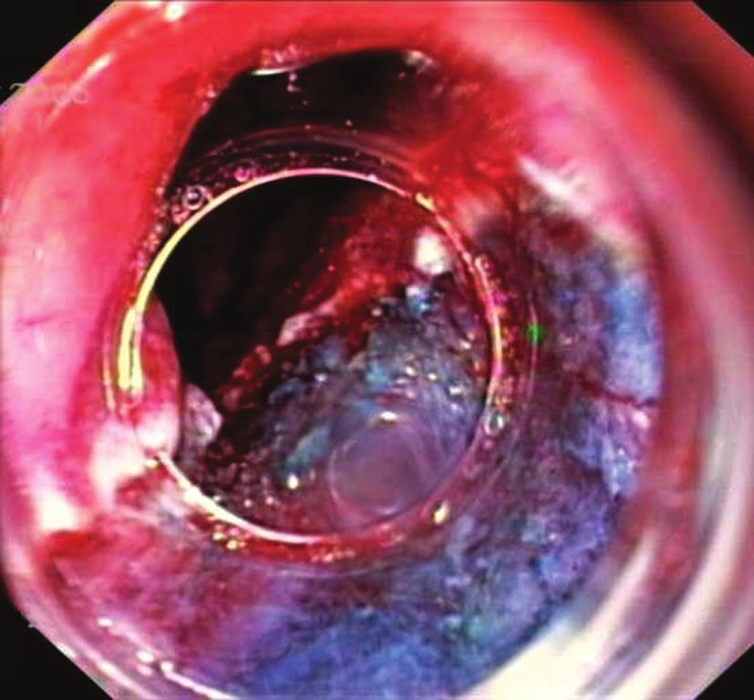 Endoscopic resection of mucosa is associated with the risk for neoplasia recurrence during follow up in up to 20% of cases [11].