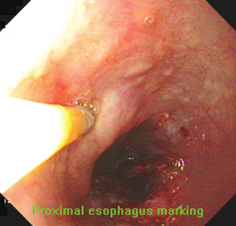 the fundus of the stomach and thus cannot fix itself to the wall [22]. Sometimes only the superior pole marking is mandatory (Fig. 12).