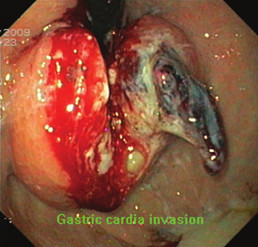 A self-expandable metallic stent deployed across the gastroesophageal junction leads to gastroesophageal reflux in most patients [22].