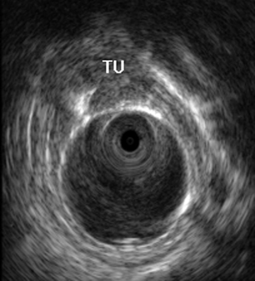 allow local staging by accurately discriminating T2 stages from early T stages (T1) suited for EMR (Fig. 13).